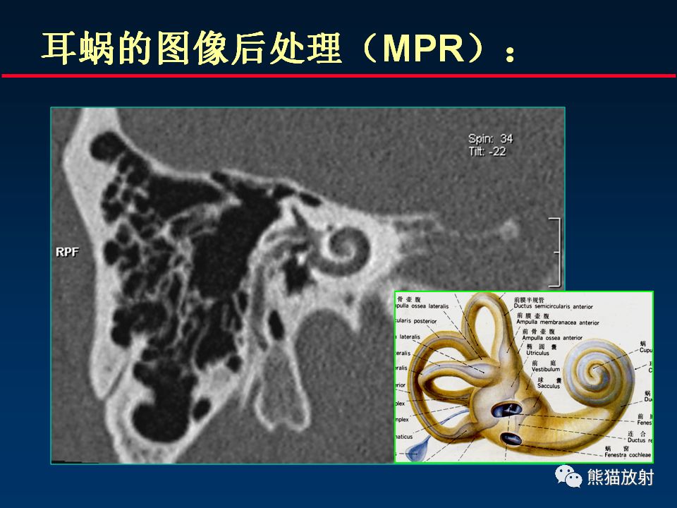 【PPT】颅底重要CT解剖及其临床意义