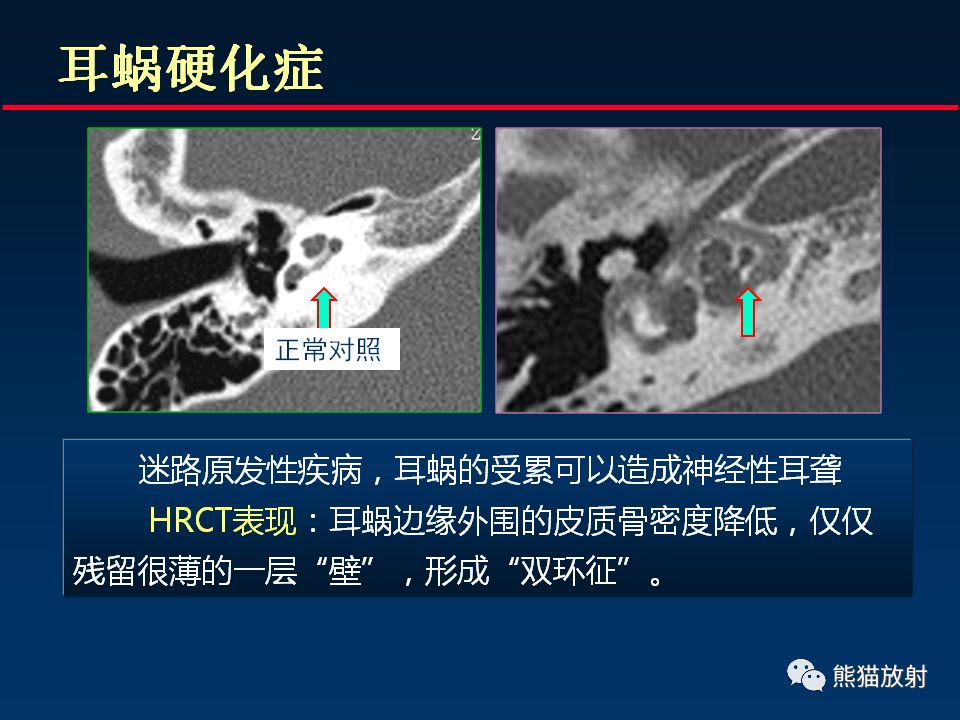 【PPT】颅底重要CT解剖及其临床意义