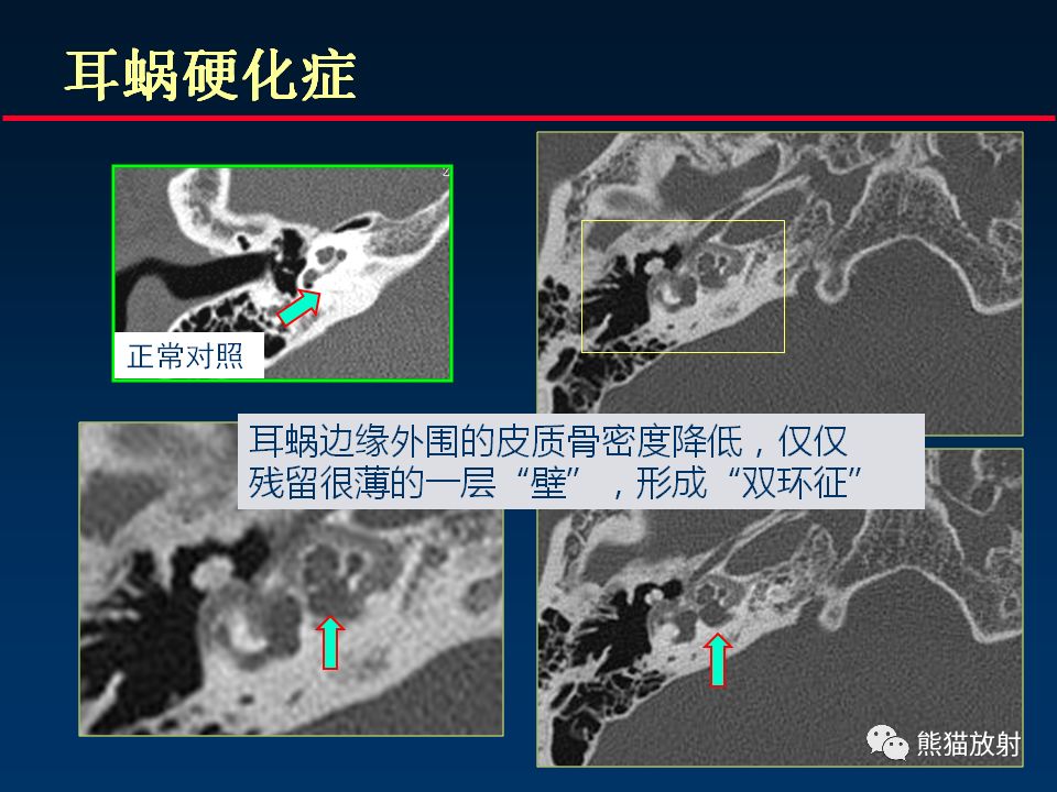 【PPT】颅底重要CT解剖及其临床意义