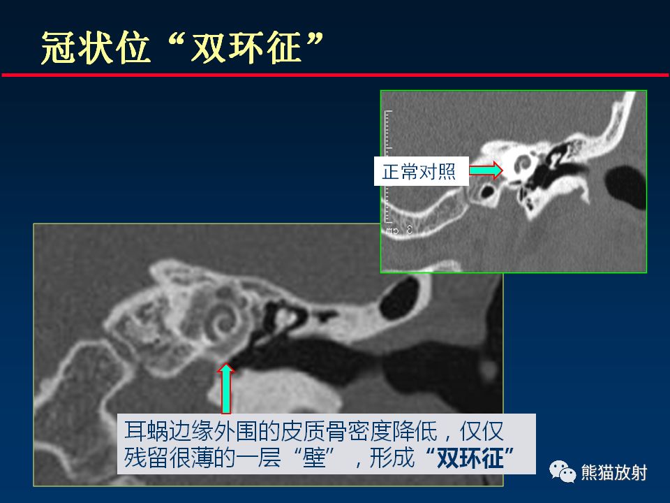 【PPT】颅底重要CT解剖及其临床意义