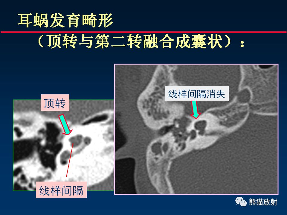 【PPT】颅底重要CT解剖及其临床意义