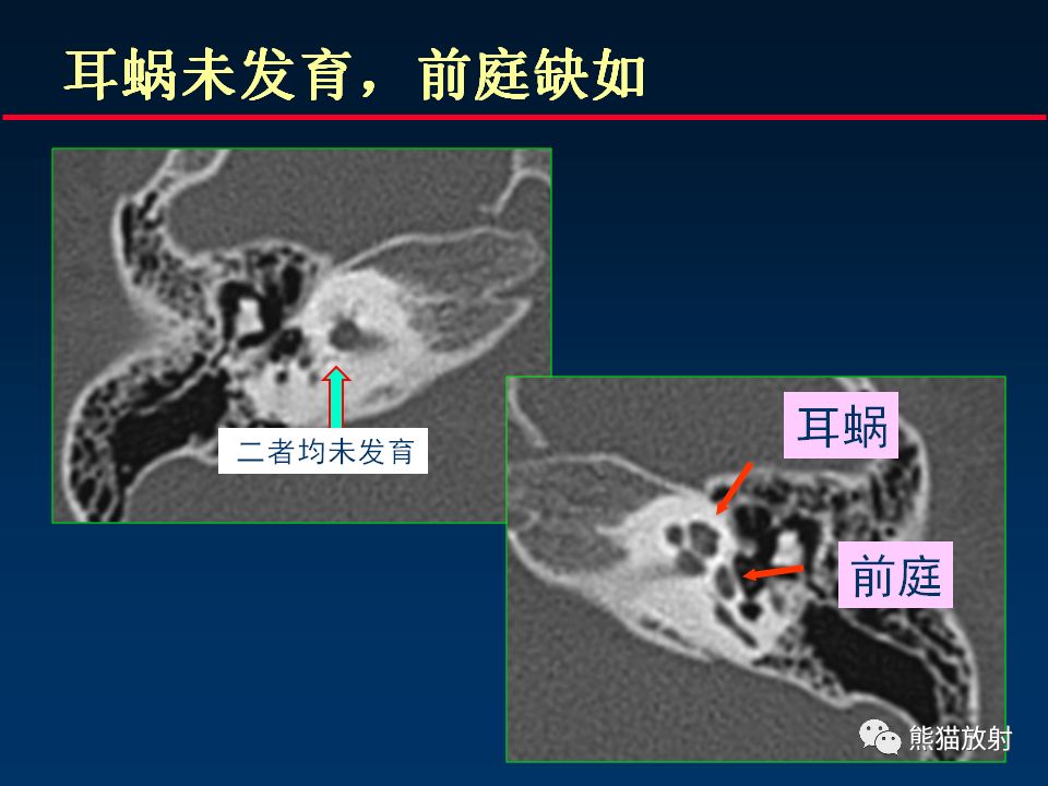 【PPT】颅底重要CT解剖及其临床意义