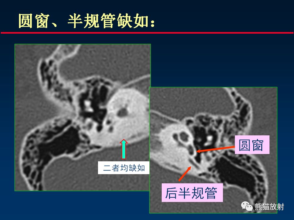 【PPT】颅底重要CT解剖及其临床意义