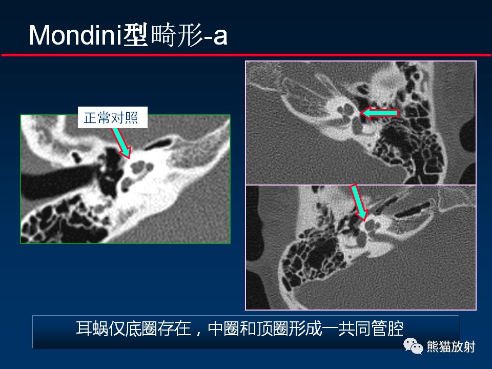 【PPT】颅底重要CT解剖及其临床意义