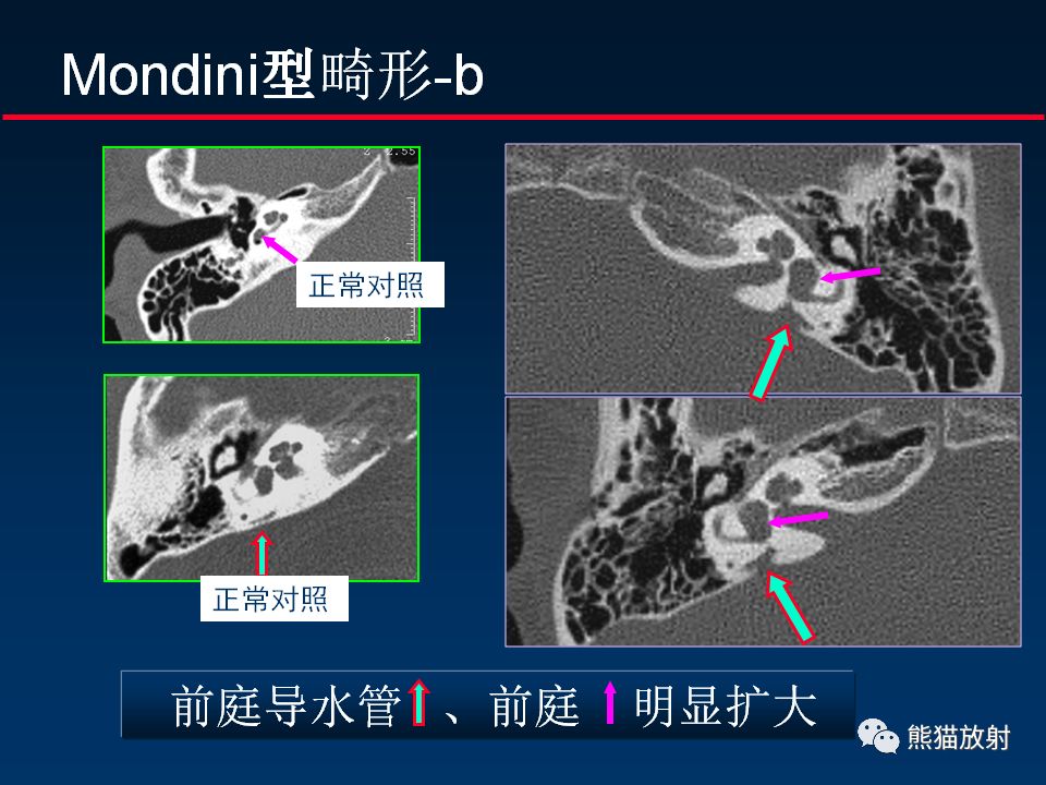 【PPT】颅底重要CT解剖及其临床意义