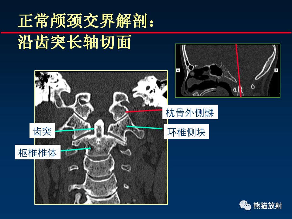【PPT】颅底重要CT解剖及其临床意义