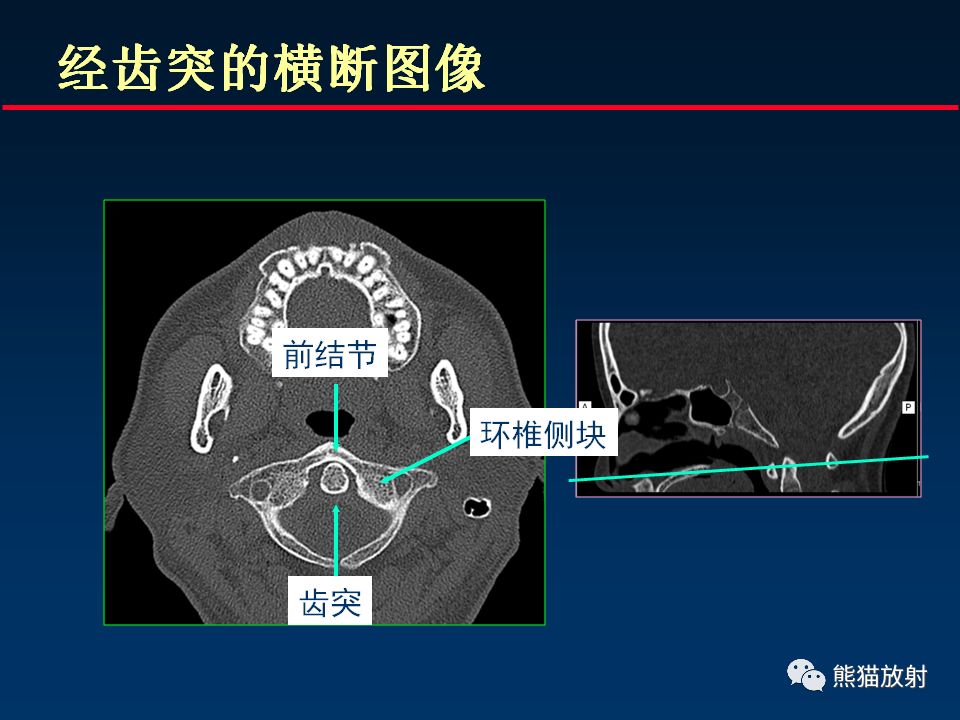【PPT】颅底重要CT解剖及其临床意义