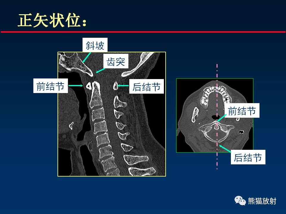 【PPT】颅底重要CT解剖及其临床意义