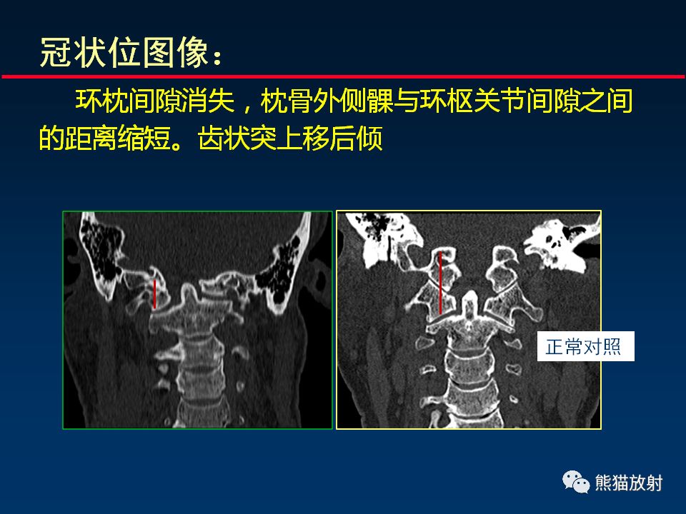 【PPT】颅底重要CT解剖及其临床意义