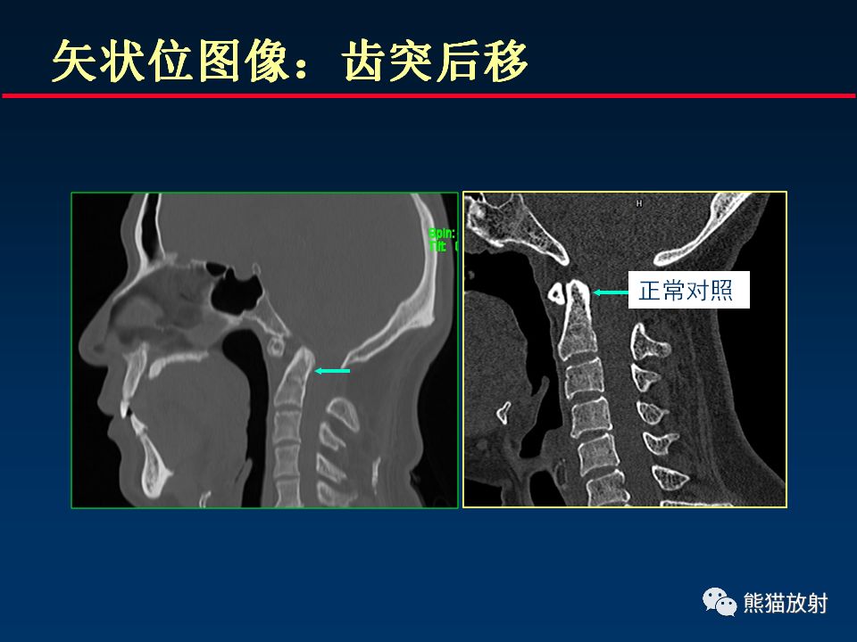 【PPT】颅底重要CT解剖及其临床意义