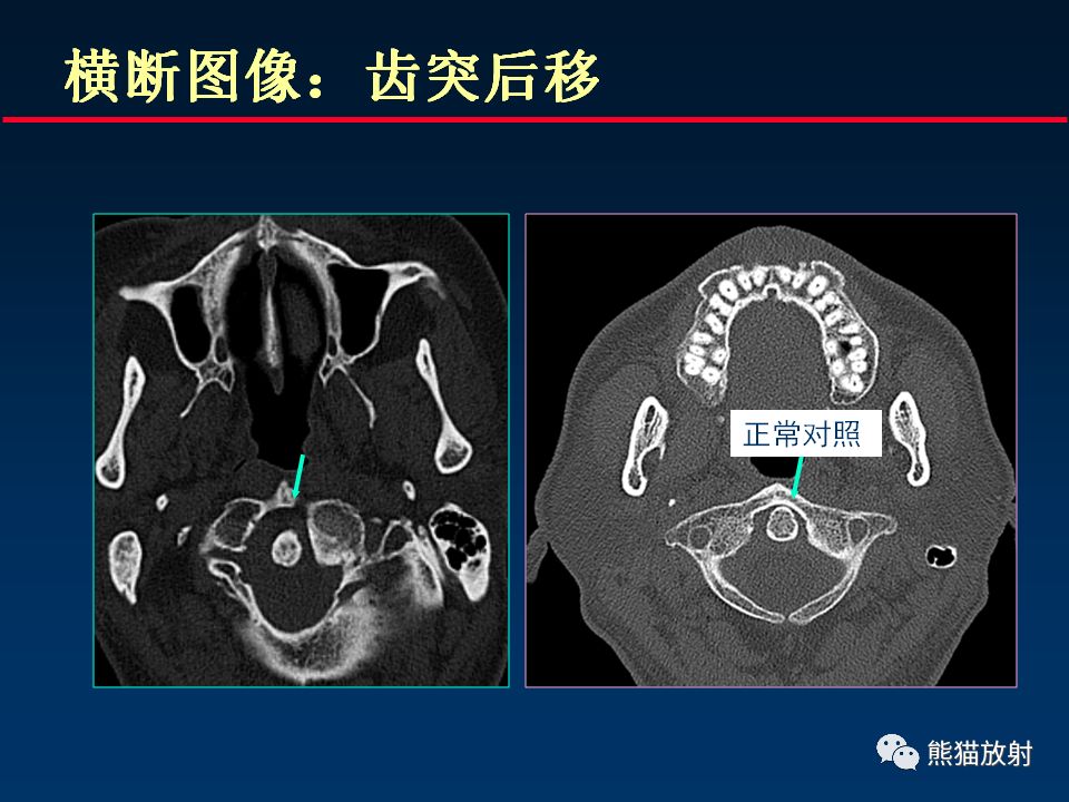 【PPT】颅底重要CT解剖及其临床意义