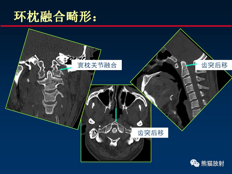 【PPT】颅底重要CT解剖及其临床意义