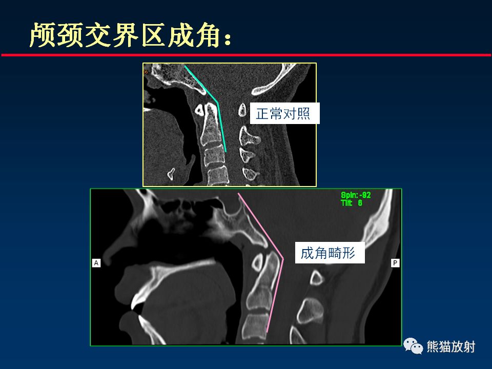 【PPT】颅底重要CT解剖及其临床意义