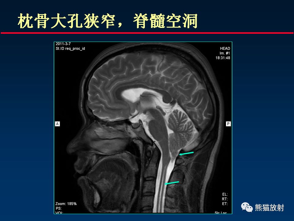 【PPT】颅底重要CT解剖及其临床意义