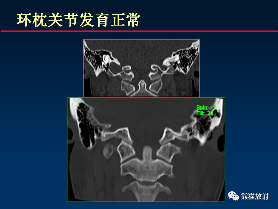【PPT】颅底重要CT解剖及其临床意义