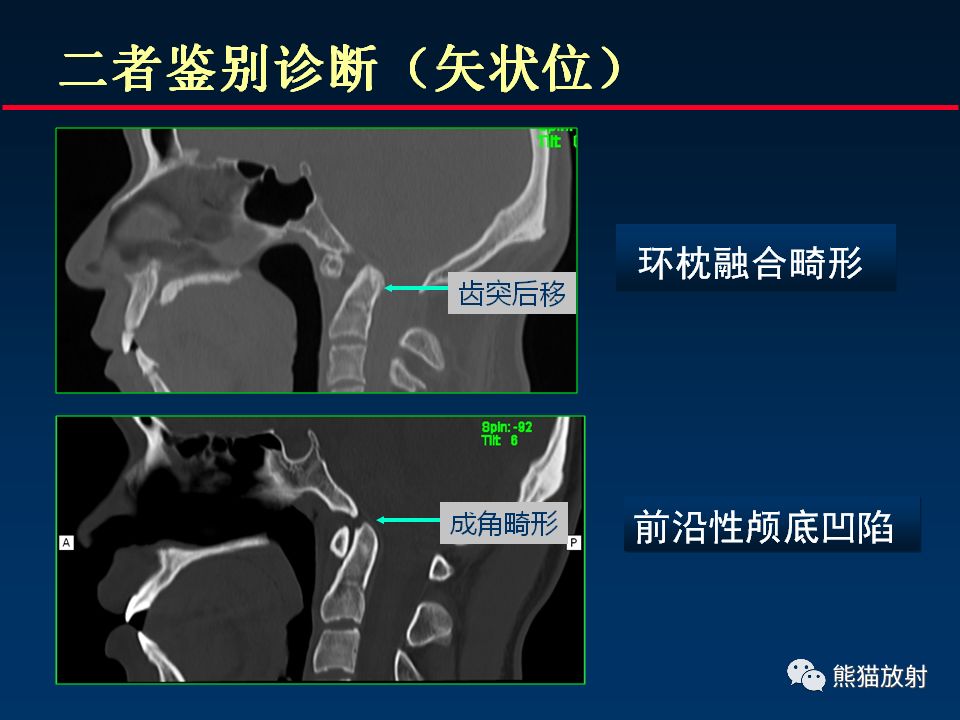 【PPT】颅底重要CT解剖及其临床意义