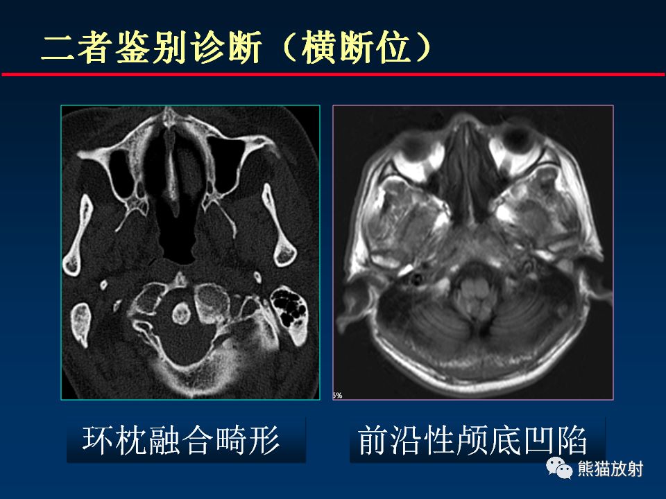 【PPT】颅底重要CT解剖及其临床意义
