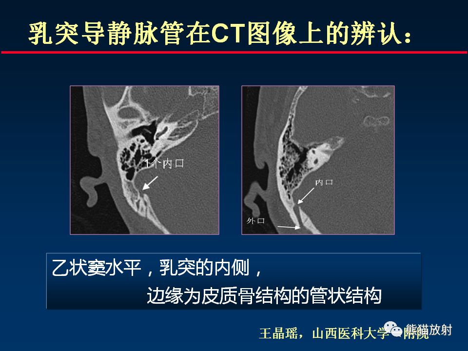 【PPT】颅底重要CT解剖及其临床意义
