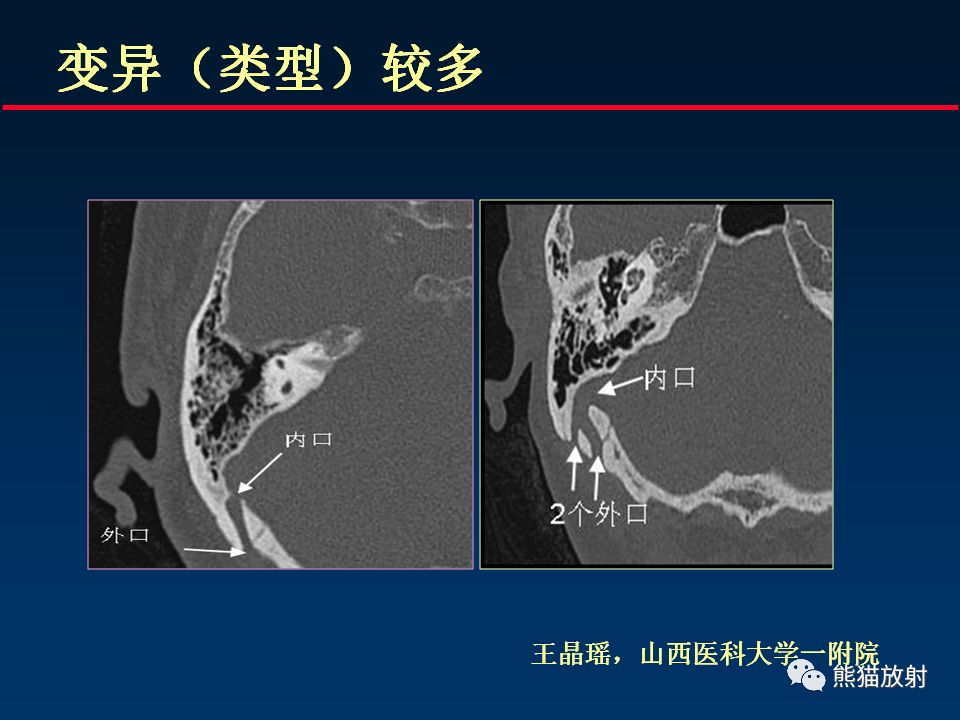 【PPT】颅底重要CT解剖及其临床意义