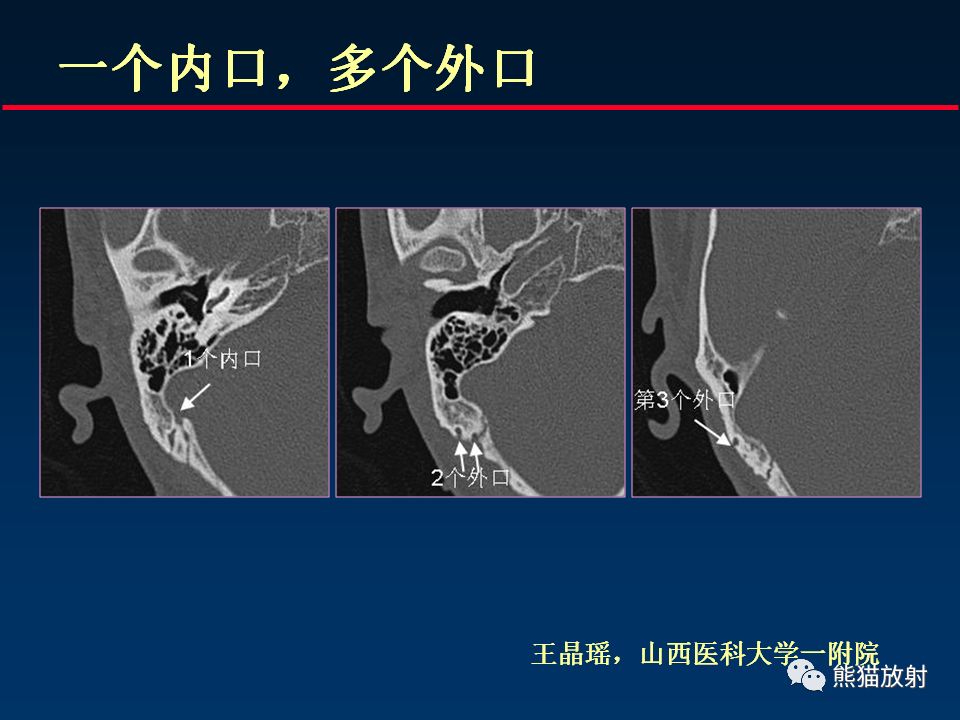 【PPT】颅底重要CT解剖及其临床意义