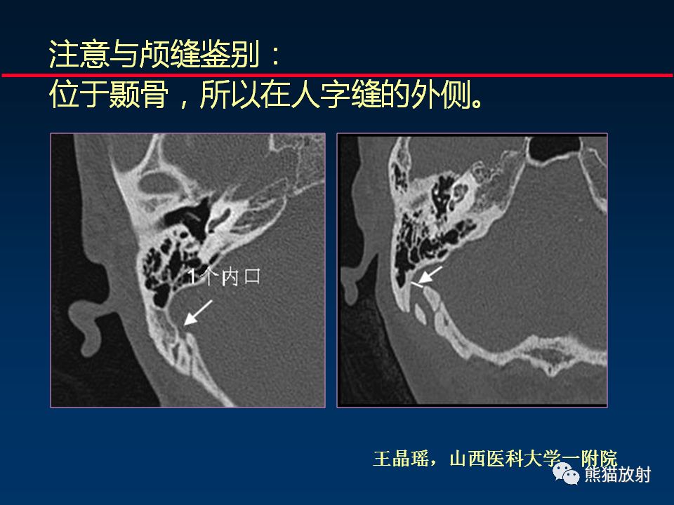 【PPT】颅底重要CT解剖及其临床意义