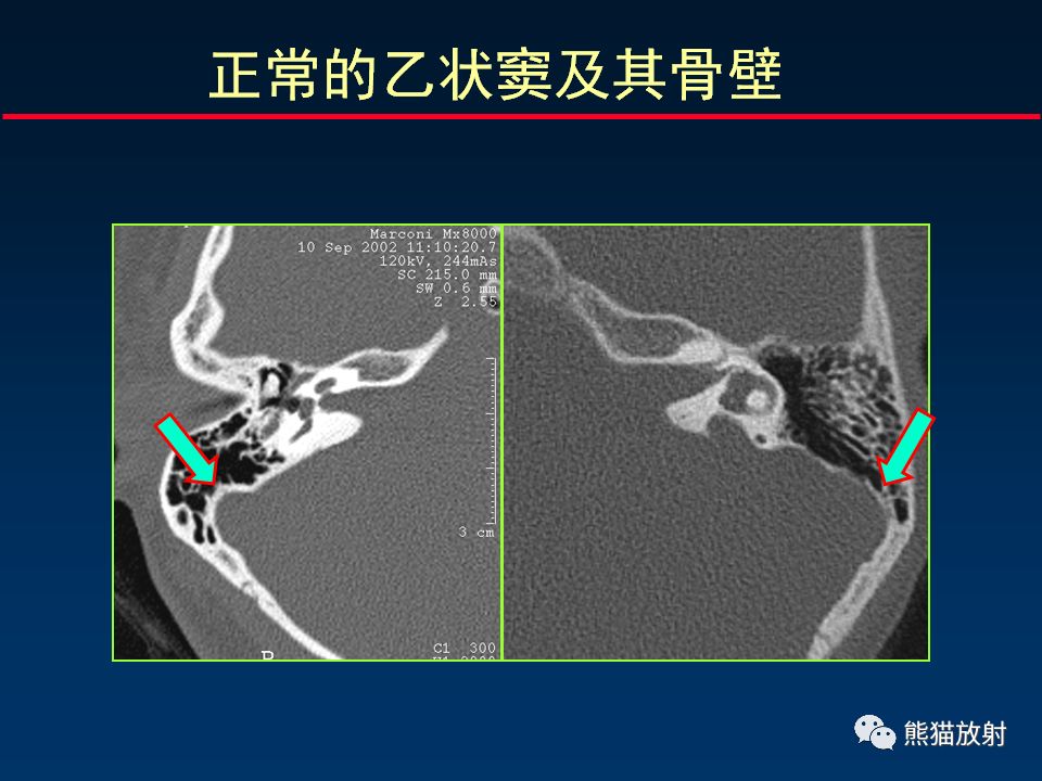 【PPT】颅底重要CT解剖及其临床意义