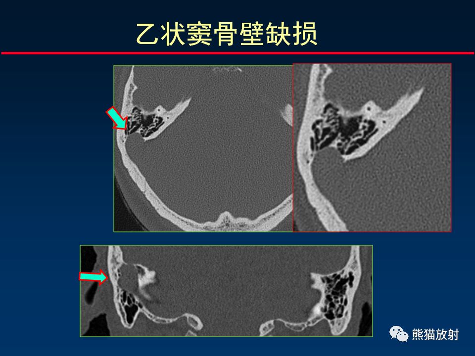 【PPT】颅底重要CT解剖及其临床意义