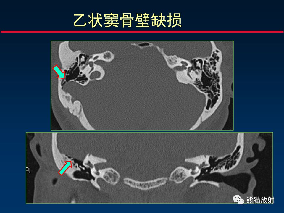 【PPT】颅底重要CT解剖及其临床意义