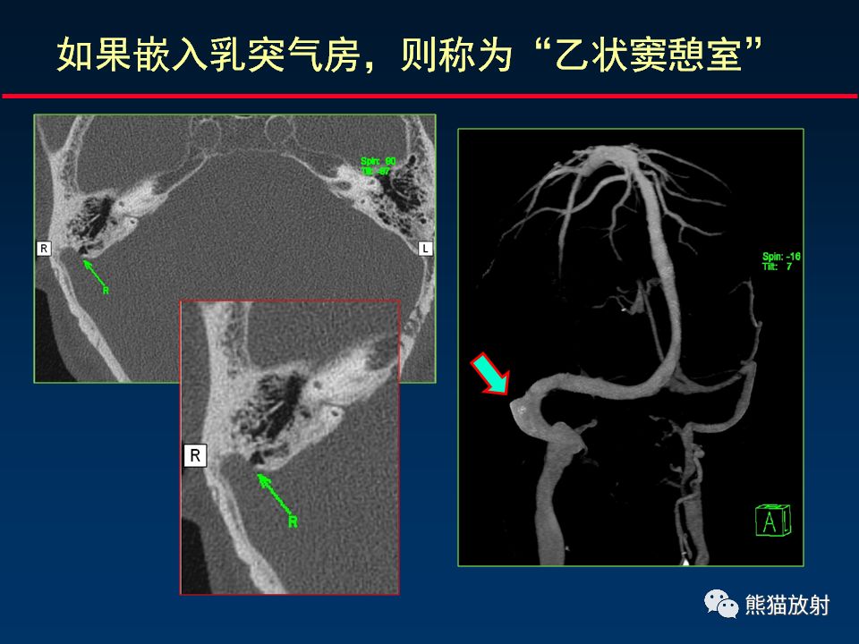 【PPT】颅底重要CT解剖及其临床意义