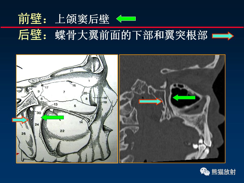 【PPT】颅底重要CT解剖及其临床意义