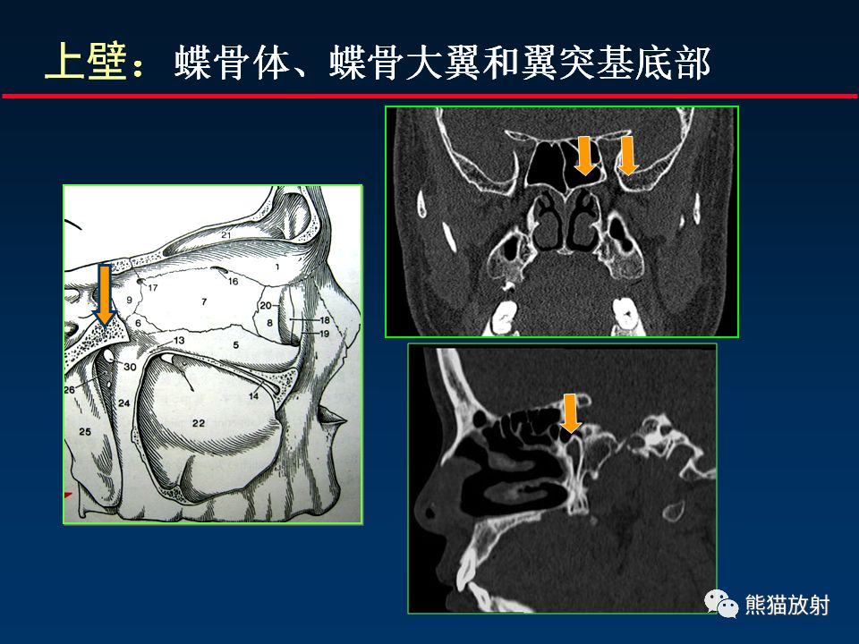 【PPT】颅底重要CT解剖及其临床意义
