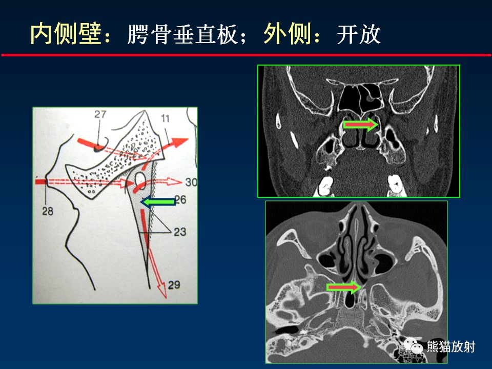 【PPT】颅底重要CT解剖及其临床意义