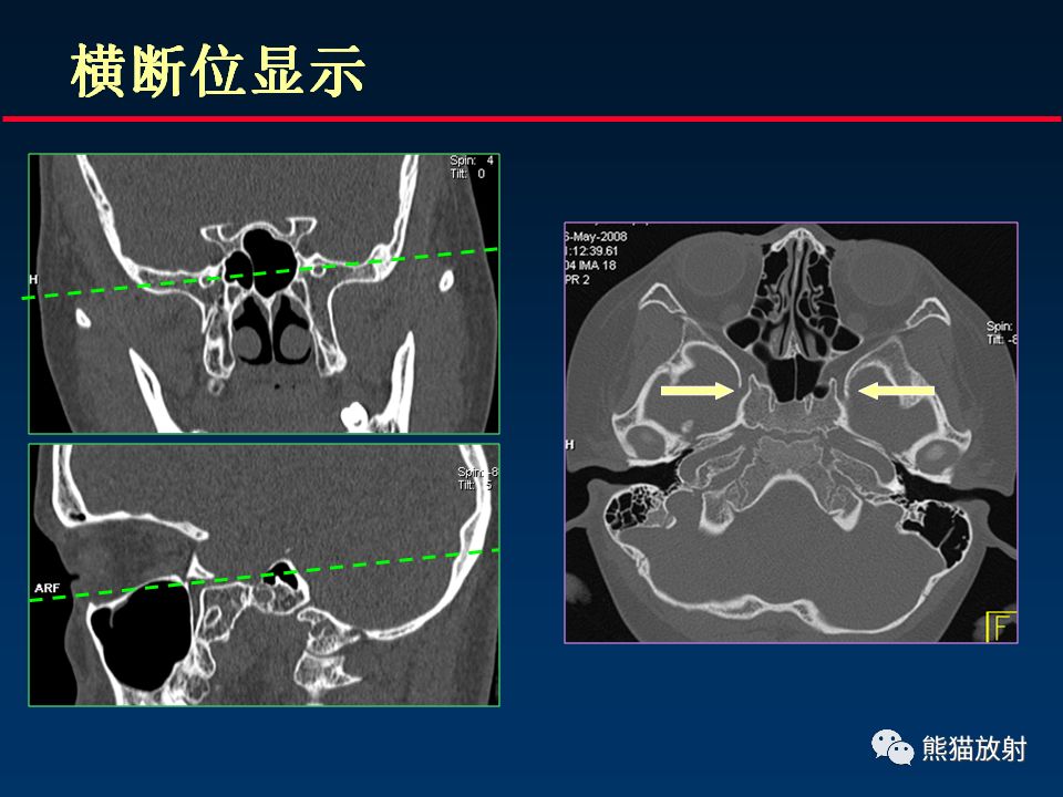 【PPT】颅底重要CT解剖及其临床意义