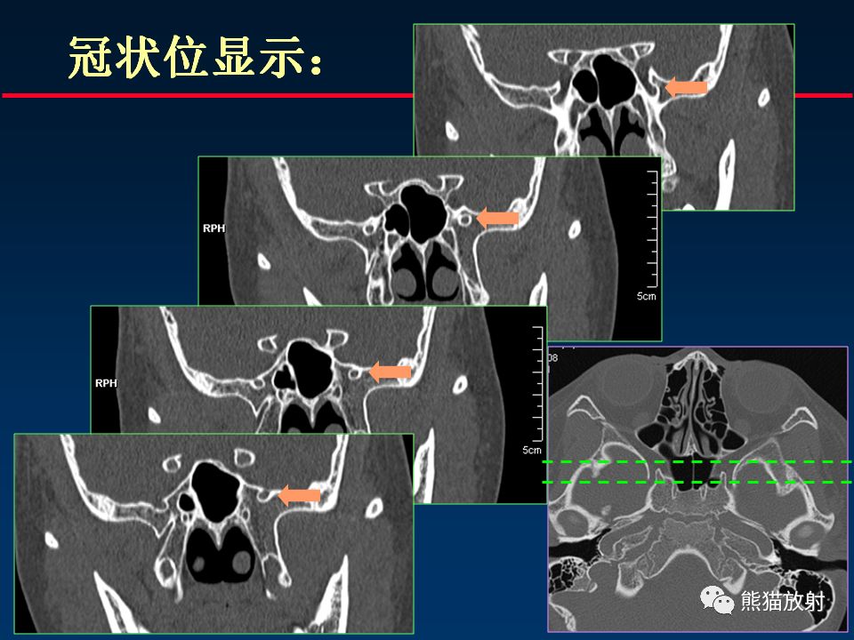 【PPT】颅底重要CT解剖及其临床意义