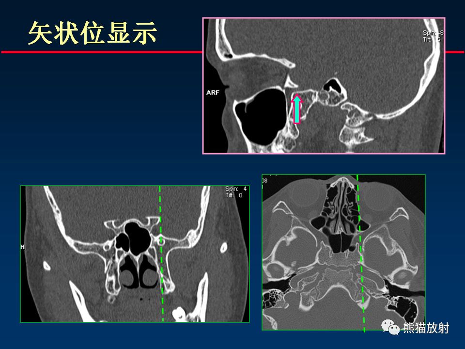 【PPT】颅底重要CT解剖及其临床意义