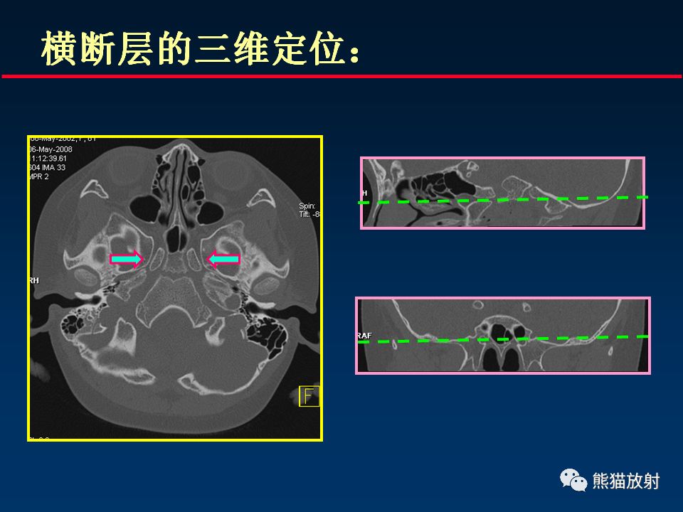 【PPT】颅底重要CT解剖及其临床意义