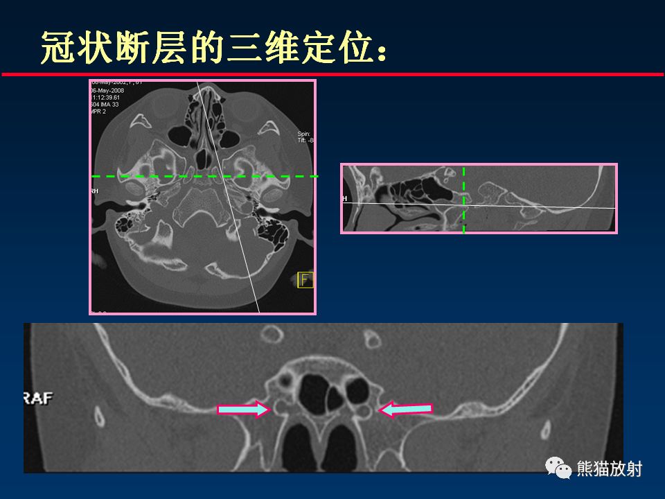 【PPT】颅底重要CT解剖及其临床意义