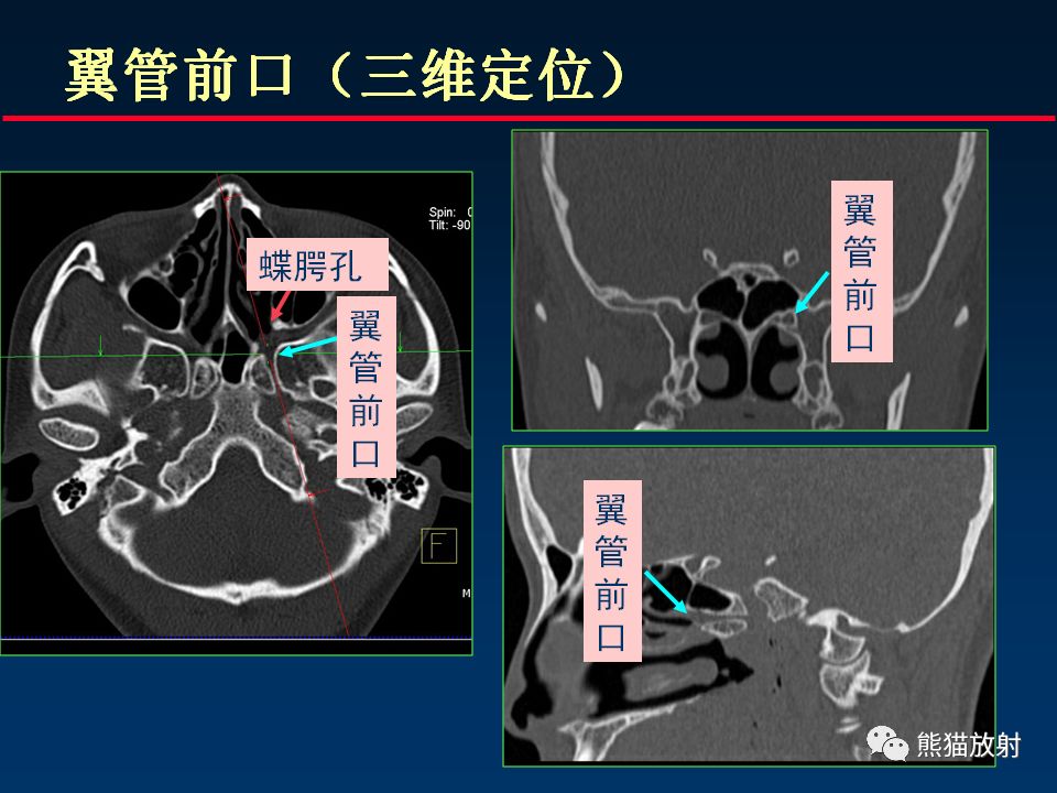 【PPT】颅底重要CT解剖及其临床意义