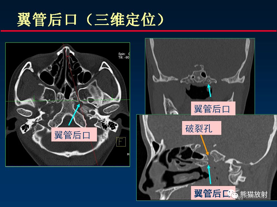 【PPT】颅底重要CT解剖及其临床意义