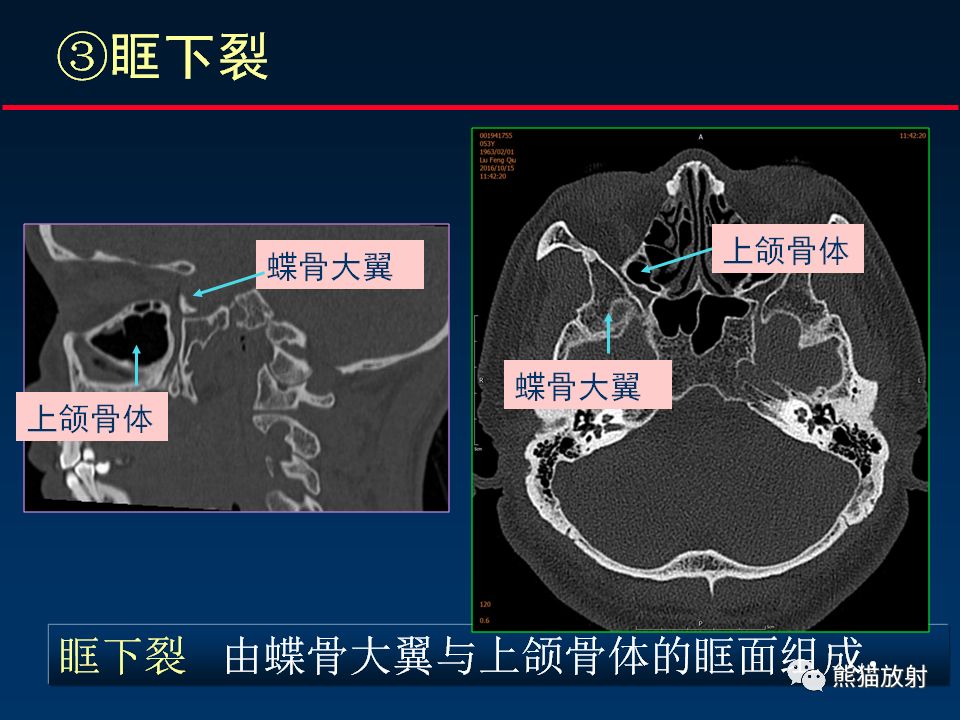【PPT】颅底重要CT解剖及其临床意义