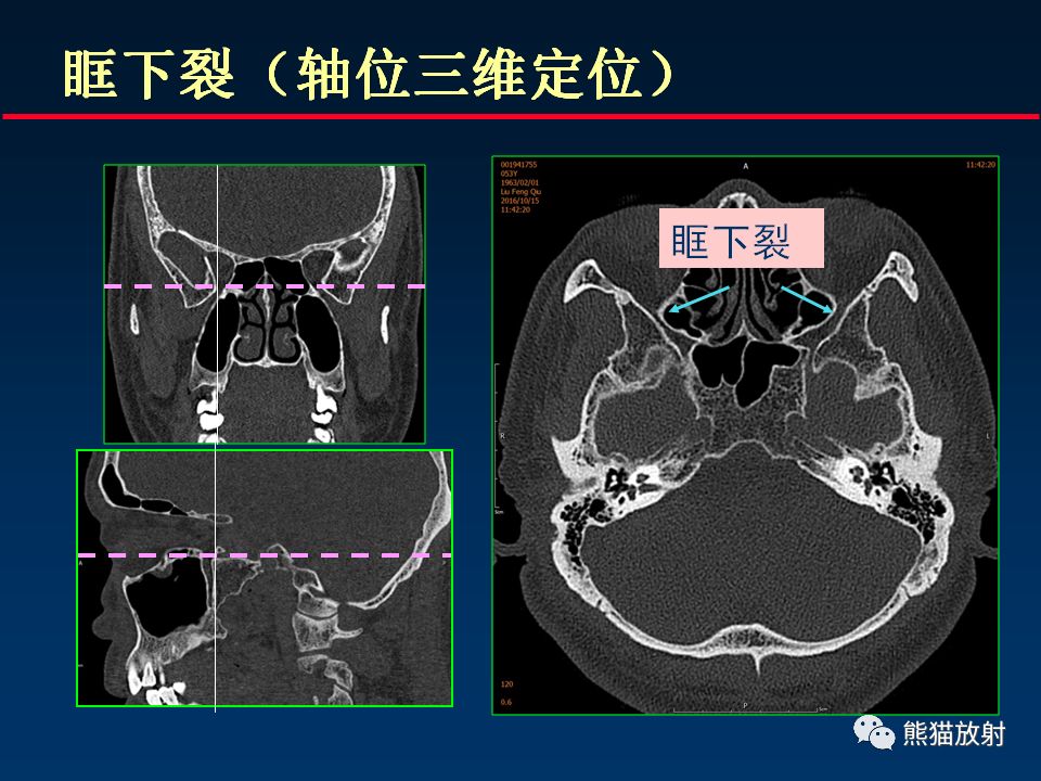 【PPT】颅底重要CT解剖及其临床意义