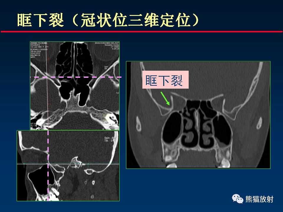 【PPT】颅底重要CT解剖及其临床意义