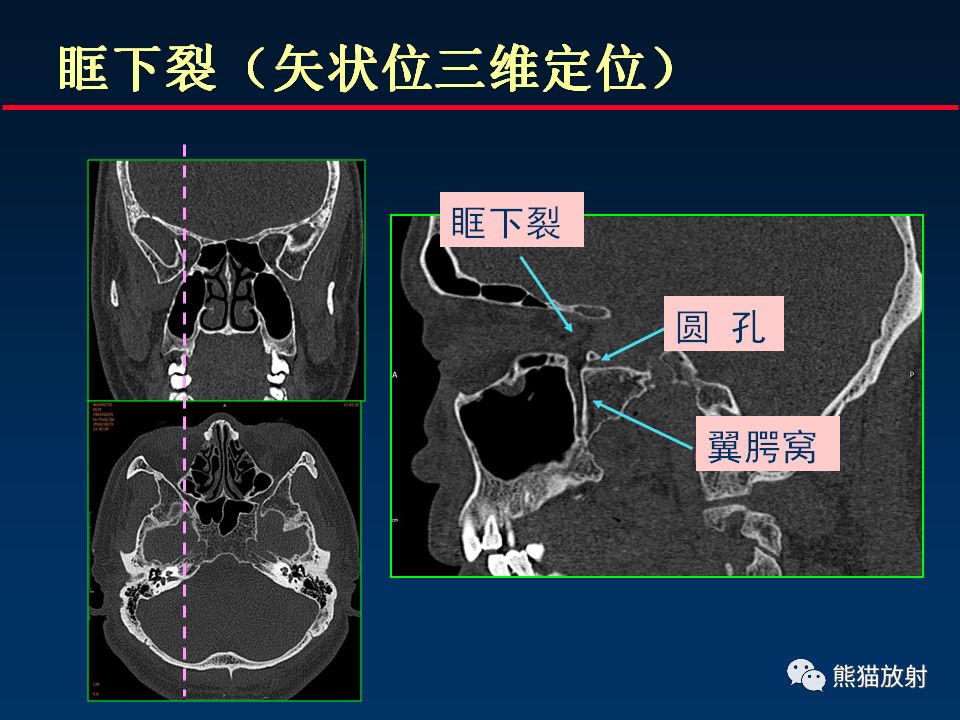 【PPT】颅底重要CT解剖及其临床意义