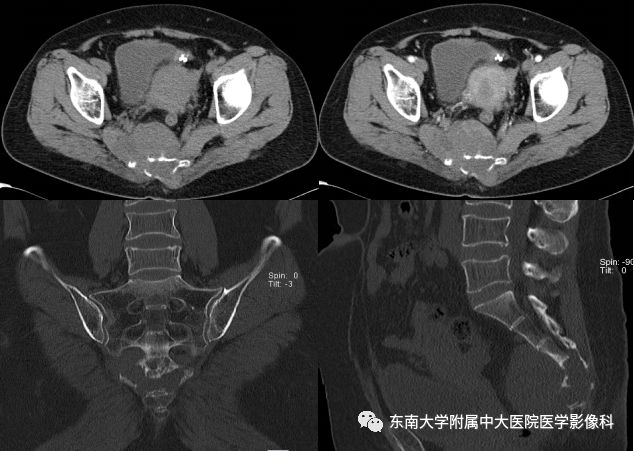 【病例】骶尾部脊索瘤1例CT及MR影像诊断