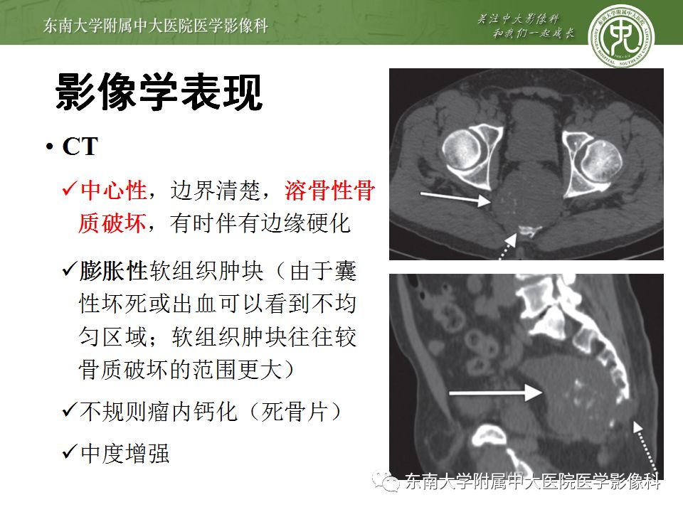 【病例】骶尾部脊索瘤1例CT及MR影像诊断