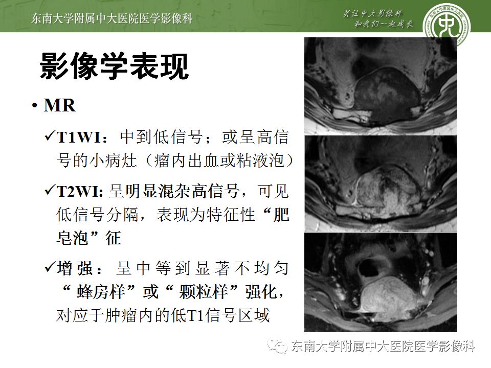【病例】骶尾部脊索瘤1例CT及MR影像诊断