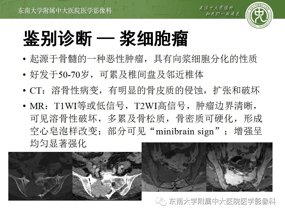 【病例】骶尾部脊索瘤1例CT及MR影像诊断