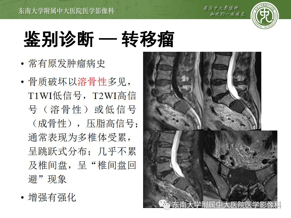 【病例】骶尾部脊索瘤1例CT及MR影像诊断