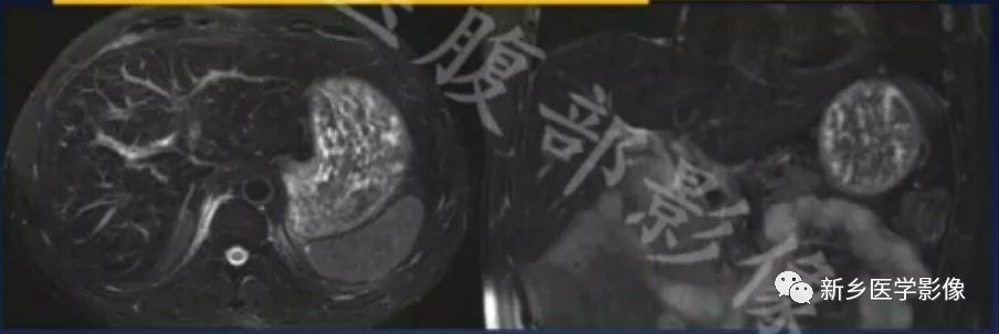 脂肪肝,大学问,看磁共振分析 脂肪肝,大学问,看磁共振分析