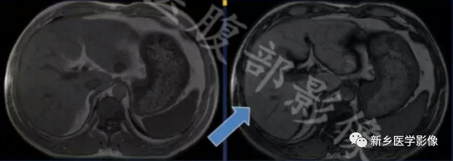 脂肪肝,大学问,看磁共振分析 脂肪肝,大学问,看磁共振分析